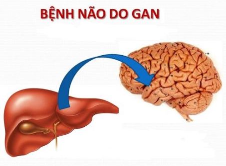 Bệnh não gan 1 Bệnh não gan 1