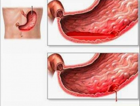 Xuất huyết tiêu hóa 1 Xuất huyết tiêu hóa 1