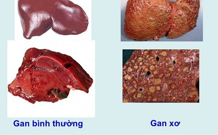 Giai đoạn 3: Giai đoạn viêm và bắt đầu hình thành sẹo 1 Giai đoạn 3: Giai đoạn viêm và bắt đầu hình thành sẹo 1