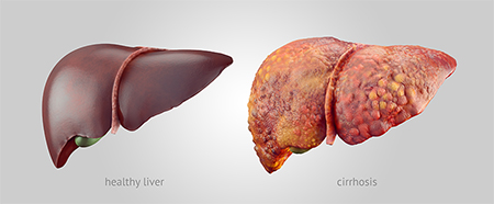 1- Xơ gan là gì? 1