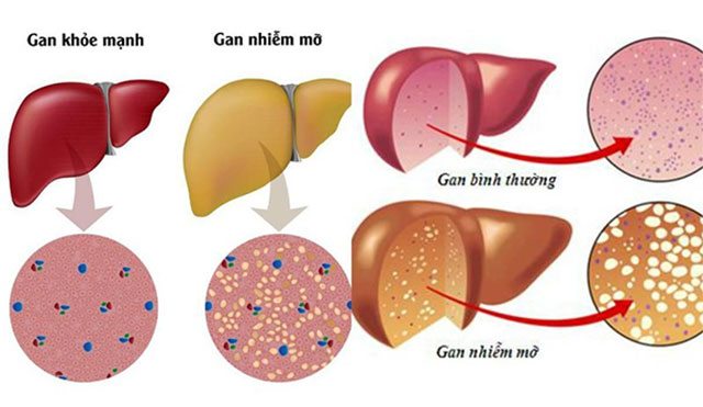 Bệnh gan nhiễm mỡ là gì - hiểu thế nào cho đúng? 1