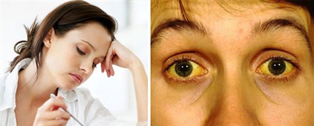 Triệu chứng của từng loại bệnh gan 1 Triệu chứng của từng loại bệnh gan 1