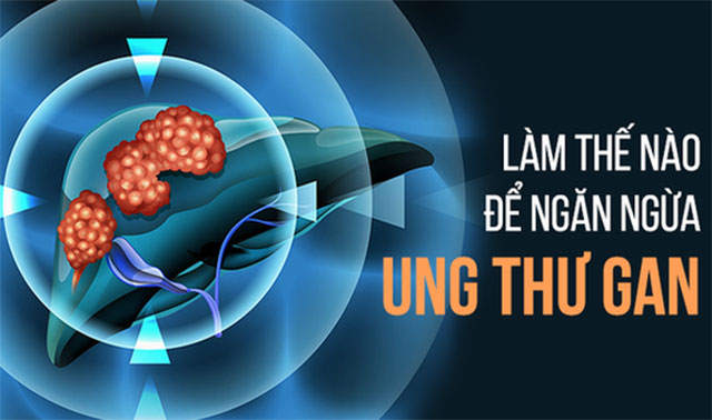 Ung thư gan- Biện pháp nào ngăn ngừa hiệu quả 1