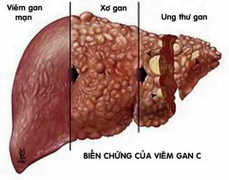 Bệnh viêm gan C mãn tính gây nhiều biến chứng nguy hiểm 1