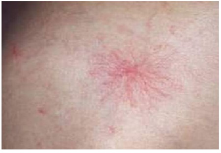 Triệu chứng của từng loại bệnh gan 3 Triệu chứng của từng loại bệnh gan 3