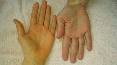 Triệu chứng của bệnh viêm gan A 1 Triệu chứng của bệnh viêm gan A 1