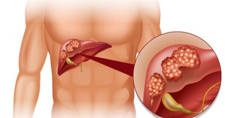 Phân biệt viêm gan B mãn tính 1