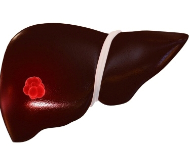 3 - Ung thư gan 1 3 - Ung thư gan 1