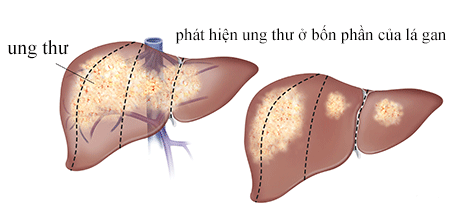 1. Nguyên nhân và các yếu tố nguy cơ bạn tuyệt đối không được lơ là 2