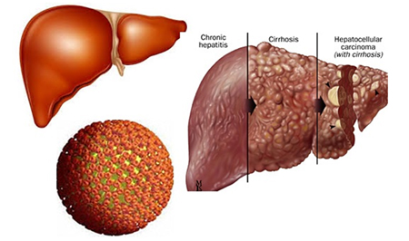 2. Virus viêm gan B – kẻ giết người thầm lặng 1 2. Virus viêm gan B – kẻ giết người thầm lặng 1