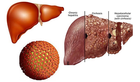 Biến chứng không lường của bệnh viêm gan B 1