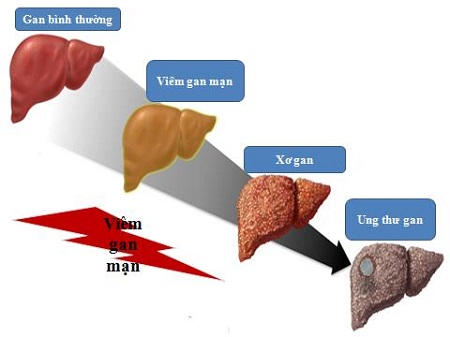 Lý do 1: Bệnh xơ gan diễn biến rất âm thầm 1 Lý do 1: Bệnh xơ gan diễn biến rất âm thầm 1