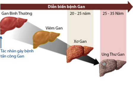 1. Xơ gan diễn biến âm thầm, nguy hại khôn lường 1 1. Xơ gan diễn biến âm thầm, nguy hại khôn lường 1