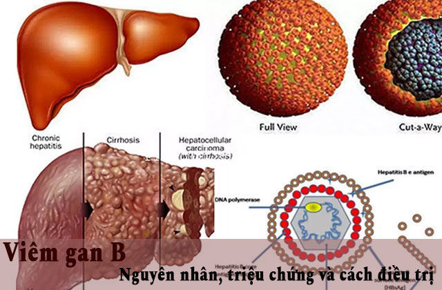 Viêm gan B – Nguyên nhân, triệu chứng và cách điều trị Viêm gan B – Nguyên nhân, triệu chứng và cách điều trị