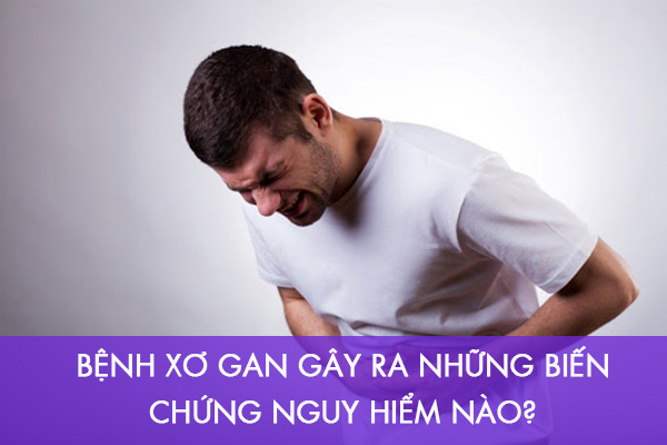 Biến chứng nguy hiểm của xơ gan cần cảnh giác 1 Biến chứng nguy hiểm của xơ gan cần cảnh giác 1