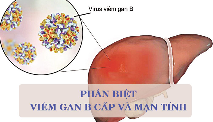 Phân biệt viêm gan B cấp tính và mãn tính 1