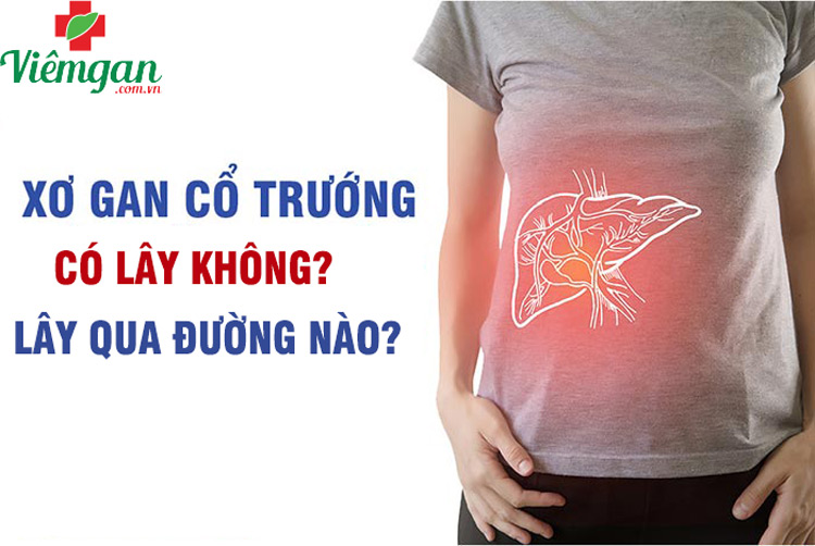 Bệnh xơ gan cổ trướng có lây không? Lây qua đường nào? 1