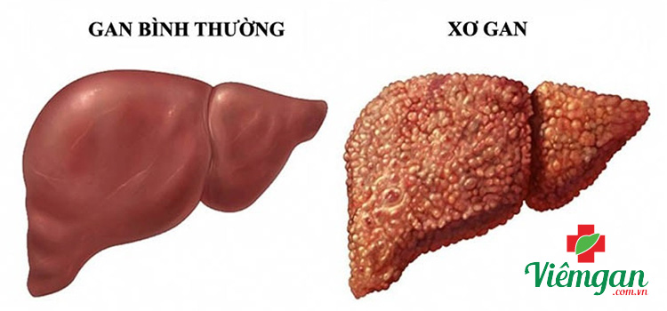 Xơ gan (sẹo ở gan) 1