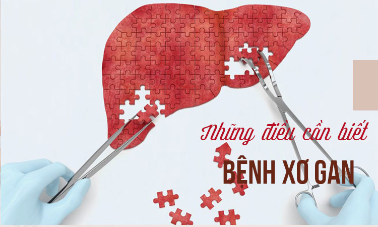 Bệnh xơ gan là gì? Sự nguy hiểm và cách điều trị ra sao ? 1