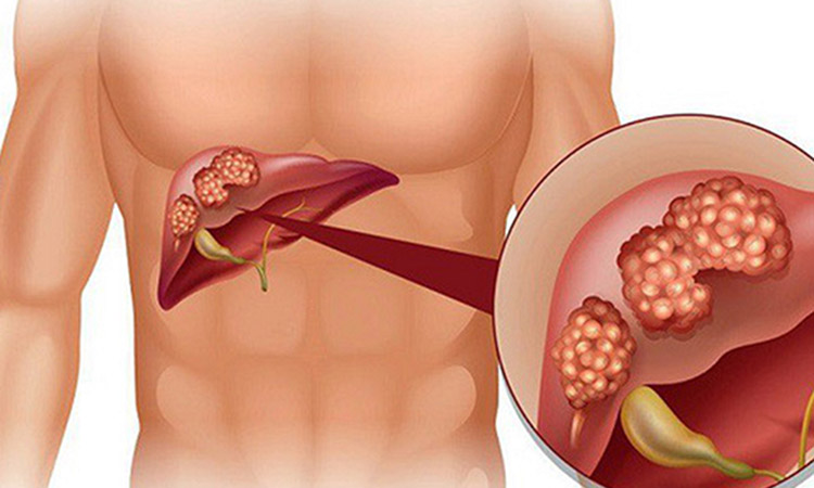 Biến chứng của viêm gan B mạn tính 1 Biến chứng của viêm gan B mạn tính 1