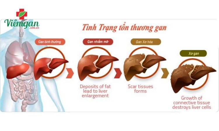 Men gan cao có thể liên quan đến các bệnh lý nguy hiểm 1