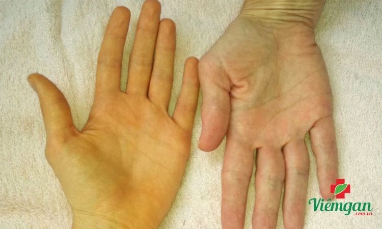 Dấu hiệu cảnh báo chức năng gan đang bị suy giảm 1