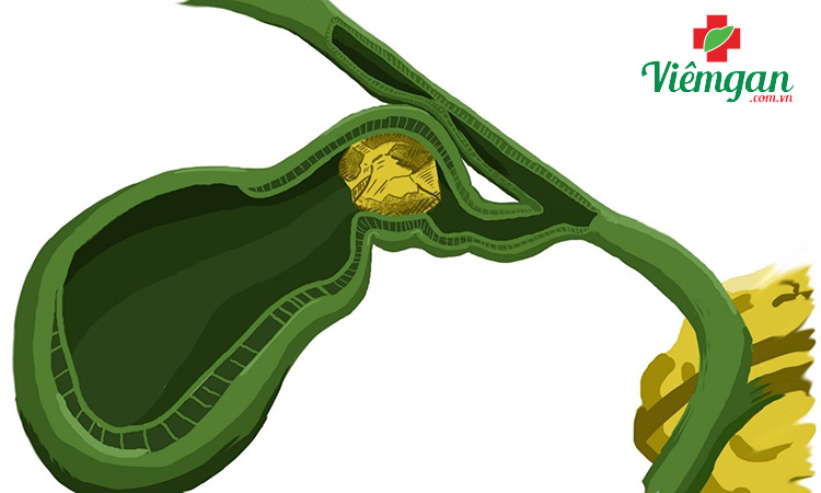 Nhóm bệnh liên quan đến ống mật chủ (vàng da sau gan) 1 Nhóm bệnh liên quan đến ống mật chủ (vàng da sau gan) 1