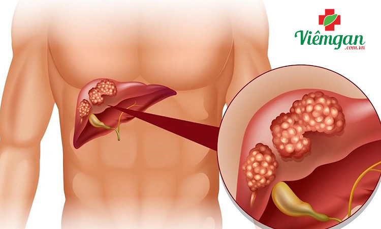 3. Ung thư gan 1 3. Ung thư gan 1