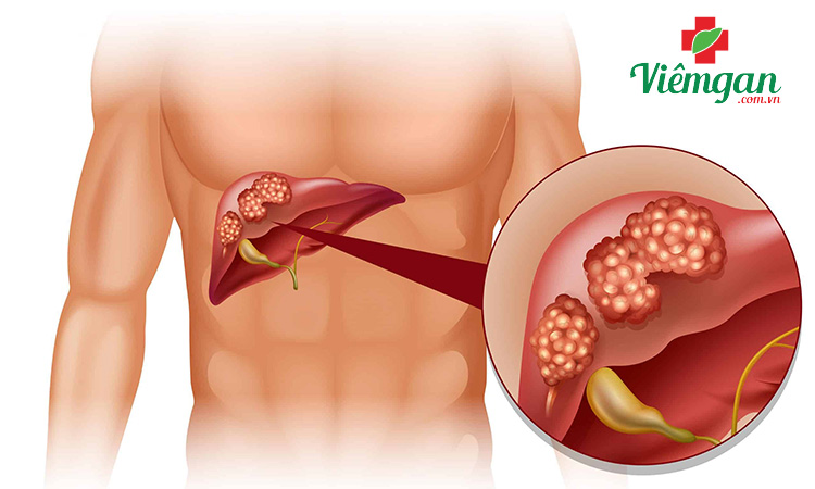 Viêm gan B mãn tính (giai đoạn cuối) 3