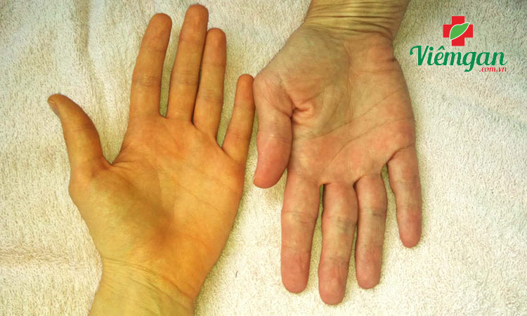 1. Nhóm bệnh liên quan đến tế bào gan (vàng da tại gan) 5 1. Nhóm bệnh liên quan đến tế bào gan (vàng da tại gan) 5