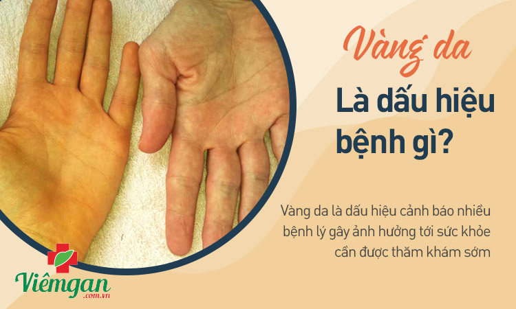 Vàng da là gì? 1 Vàng da là gì? 1