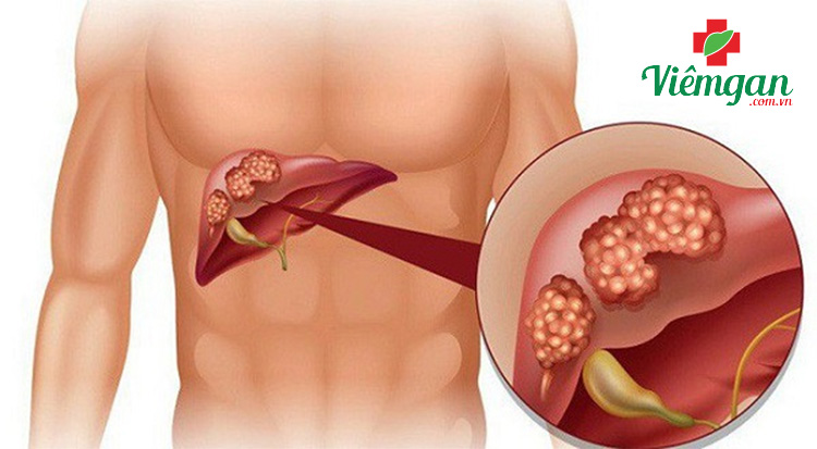 Chỉ số HbeAg âm tính nói lên điều gì? 1