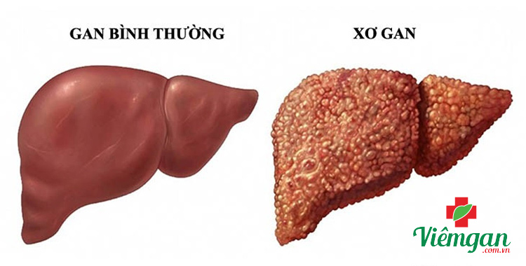 1. Nhóm bệnh liên quan đến tế bào gan (vàng da tại gan) 3 1. Nhóm bệnh liên quan đến tế bào gan (vàng da tại gan) 3