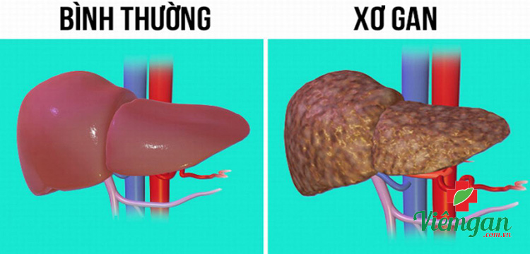 1. Xơ gan 1 1. Xơ gan 1