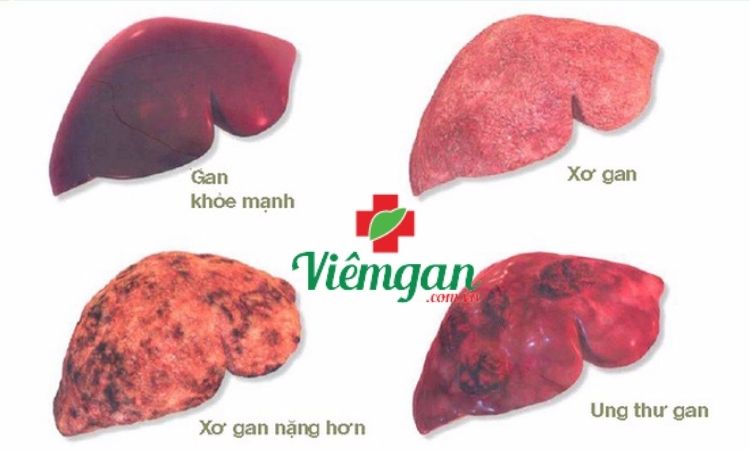 Bệnh viêm gan B nguy hiểm như thế nào? 1