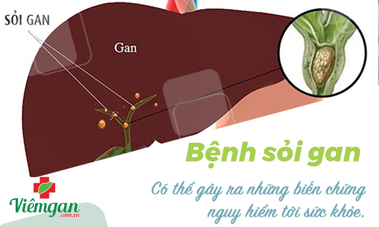 Bệnh sỏi gan là gì? Dấu hiệu nhận biết, cách trị 1