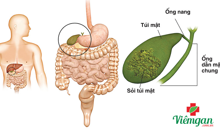 Đau do bệnh túi mật 1