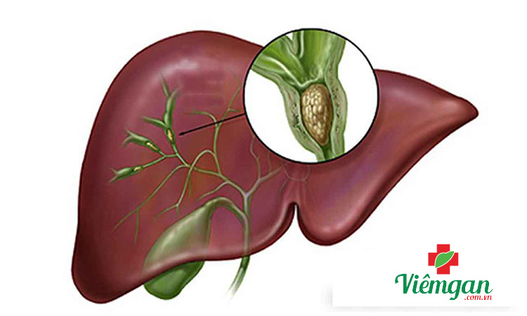 Bệnh sỏi gan là gì? 1