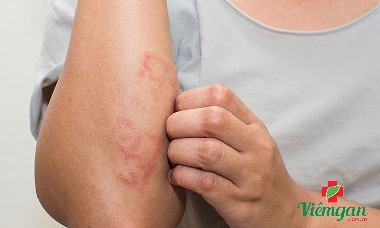 Uống thuốc giải độc gan bị ngứa phải làm sao? 1