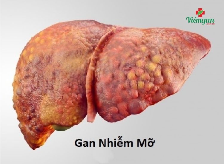 Gan nhiễm mỡ 1