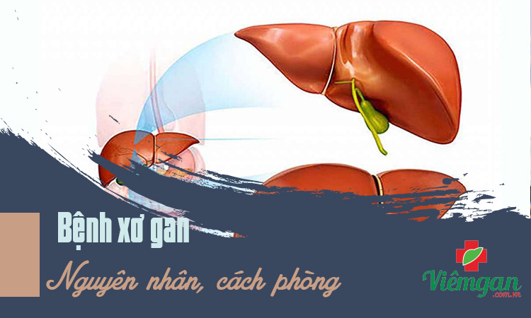 Nguyên nhân gây bệnh xơ gan và cách phòng ngừa đúng 1 Nguyên nhân gây bệnh xơ gan và cách phòng ngừa đúng 1