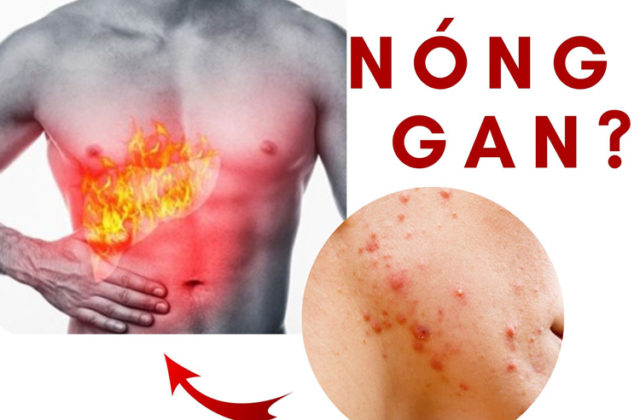 Mọc mụn do gan làm thế nào để điều trị? Mọc mụn do gan làm thế nào để điều trị?