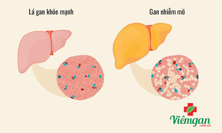 Do gan nhiễm mỡ 1 Do gan nhiễm mỡ 1