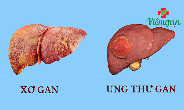 Xơ gan giai đoạn 4 thời gian sống dưới 3 năm 1