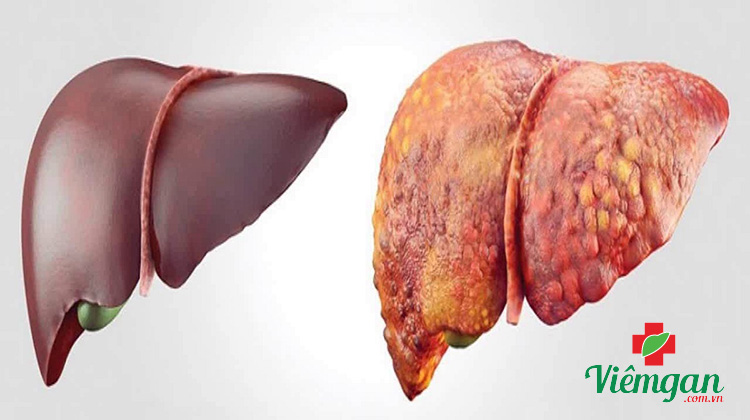 Các giai đoạn của xơ gan 1 Các giai đoạn của xơ gan 1