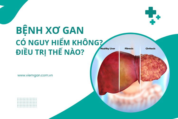 Bệnh xơ gan có nguy hiểm không? Điều trị thế nào? 1 Bệnh xơ gan có nguy hiểm không? Điều trị thế nào? 1