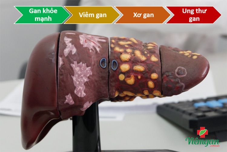 Lý do 1: Bệnh xơ gan diễn biến rất âm thầm 1 Lý do 1: Bệnh xơ gan diễn biến rất âm thầm 1