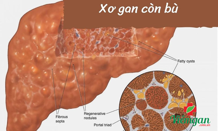 Giai đoạn xơ gan còn bù 1 Giai đoạn xơ gan còn bù 1