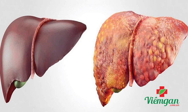 Xơ gan giai đoạn 2 sống được bao lâu? 1 Xơ gan giai đoạn 2 sống được bao lâu? 1