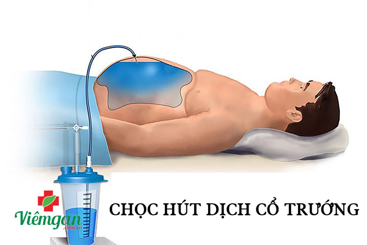 Chọc hút dịch cổ trướng 1